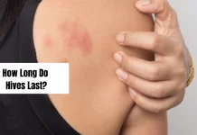 How Long Do Hives Last? – Impromise How Long Do Hives Last